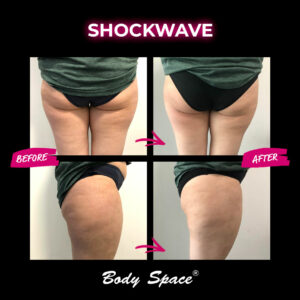 1_SHOCKWAVE_ba_bodyspace